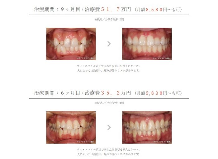 マウスピース矯正　症例